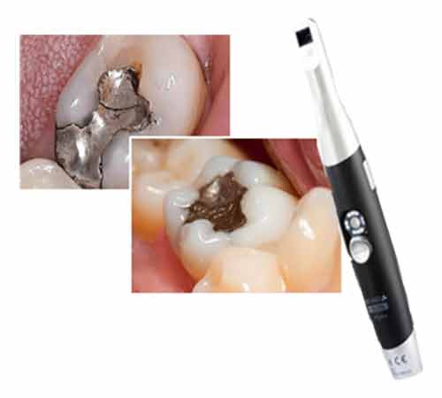 Intra oral camera