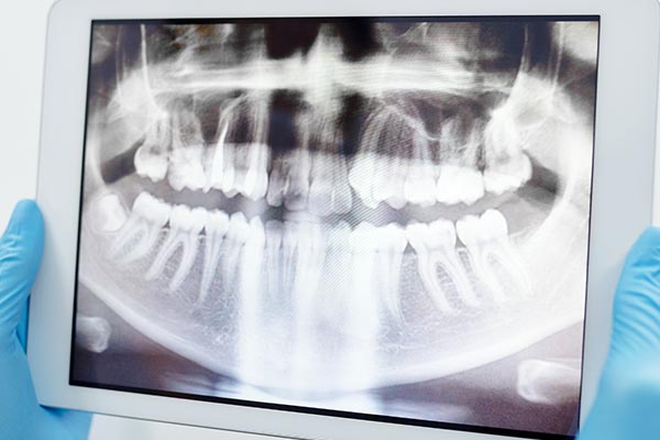 root canal xray