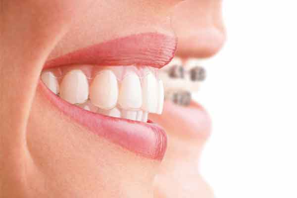 Invisalign Hawthorn Melbourne