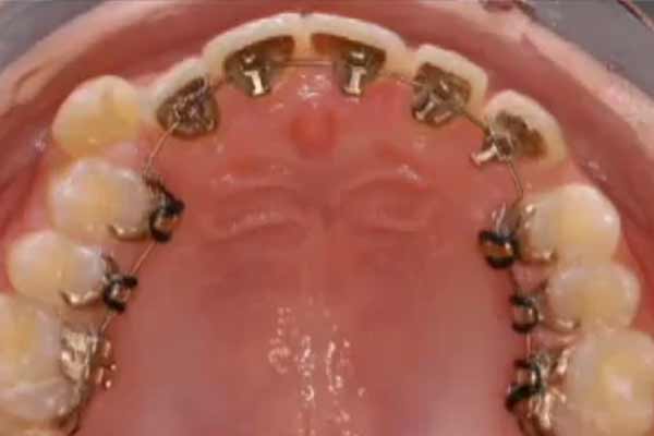 Lingual Hidden Invisible Braces