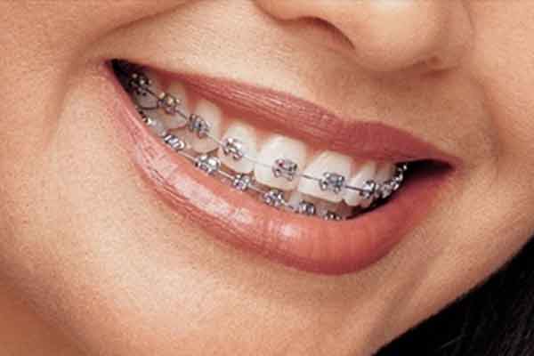 Metal kids teen Braces Hawthorn
