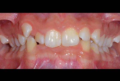 deep Bite treatment melbourne hawthorn
