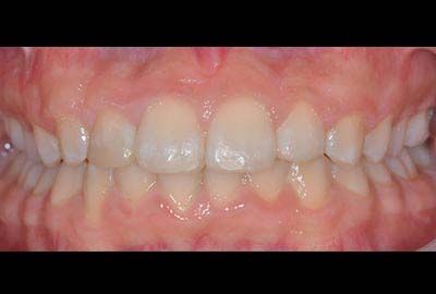 deep Bite treatment melbourne hawthorn