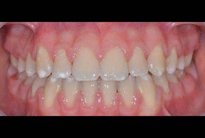 Open Bite treatment melbourne hawthorn