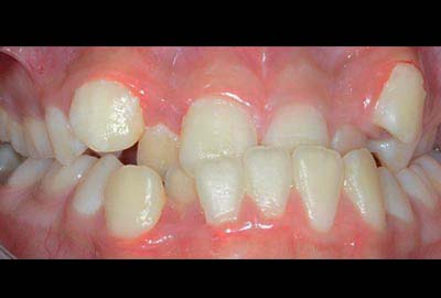 cross Bite treatment melbourne hawthorn